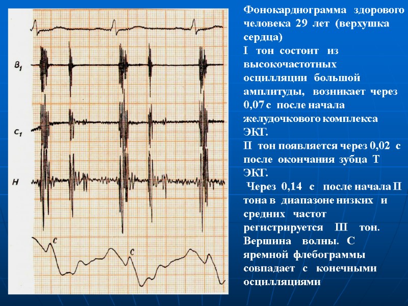 Фонокардиограмма здорового человека 29 лет (верхушка Фонокардиограмма здорового человека 29 лет (верхушка